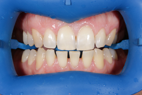 зубы до отбеливания zoom4 зубы до отбеливания zoom4